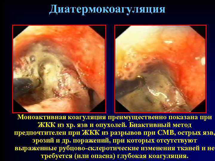 Диатермокоагуляция Моноактивная коагуляция преимущественно показана при ЖКК из хр. язв и опухолей. Биактивный метод