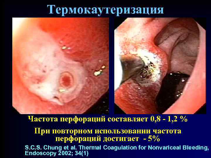 Термокаутеризация Частота перфораций составляет 0, 8 - 1, 2 % При повторном использовании частота