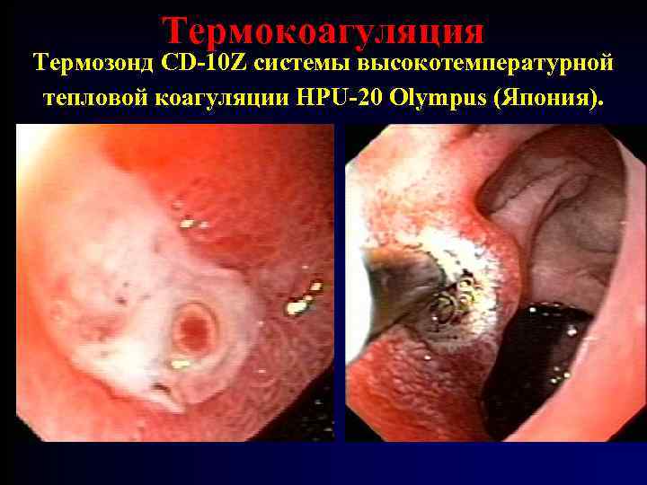 Термокоагуляция Термозонд CD-10 Z системы высокотемпературной тепловой коагуляции HPU-20 Olympus (Япония). 