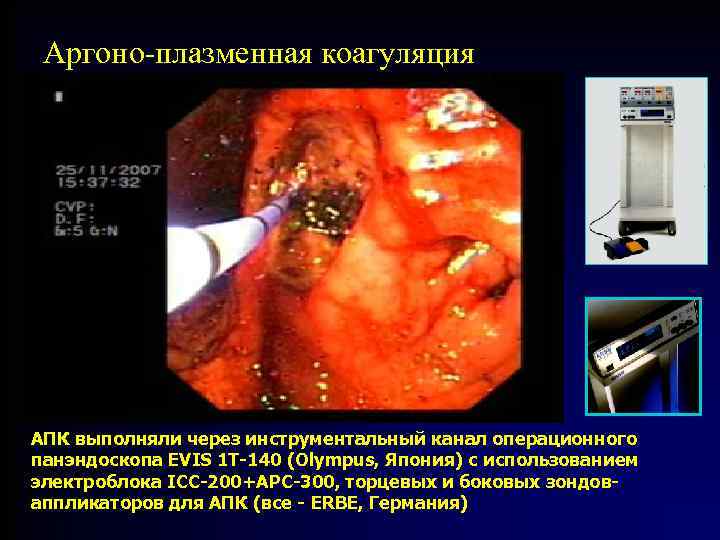 Аргоно-плазменная коагуляция АПК выполняли через инструментальный канал операционного панэндоскопа EVIS 1 T-140 (Olympus, Япония)