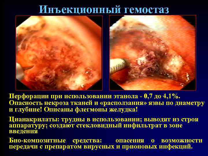 Инъекционный гемостаз Перфорации при использовании этанола - 0, 7 до 4, 1%. Опасность некроза
