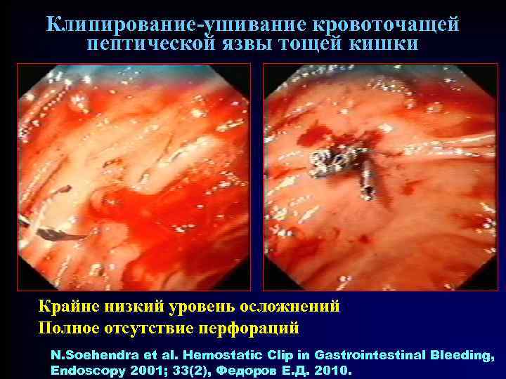 Клипирование-ушивание кровоточащей пептической язвы тощей кишки Крайне низкий уровень осложнений Полное отсутствие перфораций N.