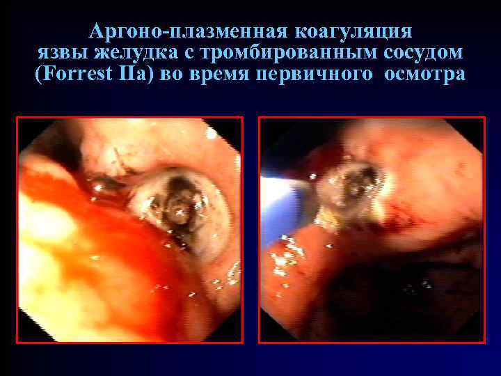 Аргоно-плазменная коагуляция язвы желудка с тромбированным сосудом (Forrest IIa) во время первичного осмотра 