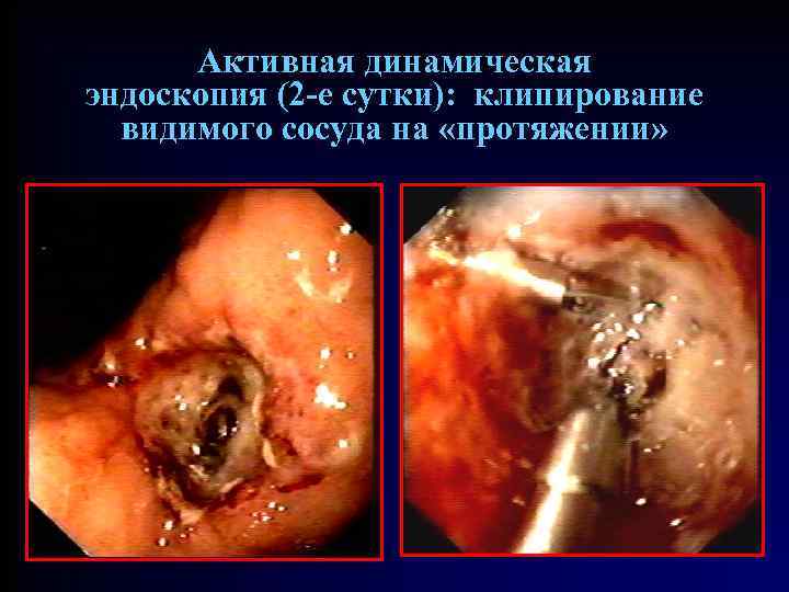 Активная динамическая эндоскопия (2 -е сутки): клипирование видимого сосуда на «протяжении» 