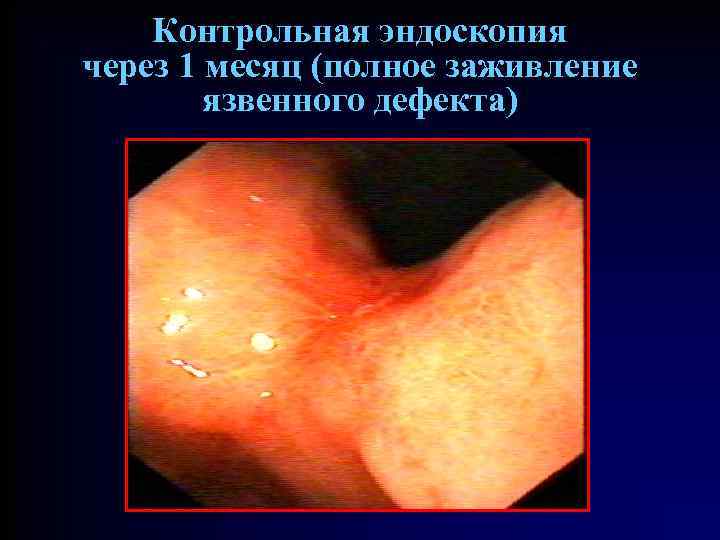 Контрольная эндоскопия через 1 месяц (полное заживление язвенного дефекта) 