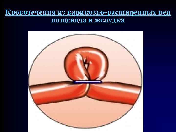 Кровотечения из варикозно-расширенных вен пищевода и желудка 