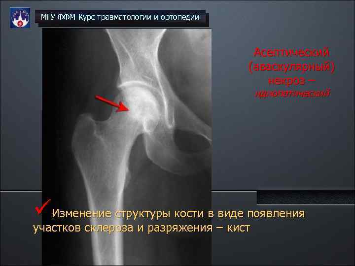 МГУ ФФМ Курс травматологии и ортопедии Асептический (аваскулярный) некроз – идиопатический üИзменение структуры кости