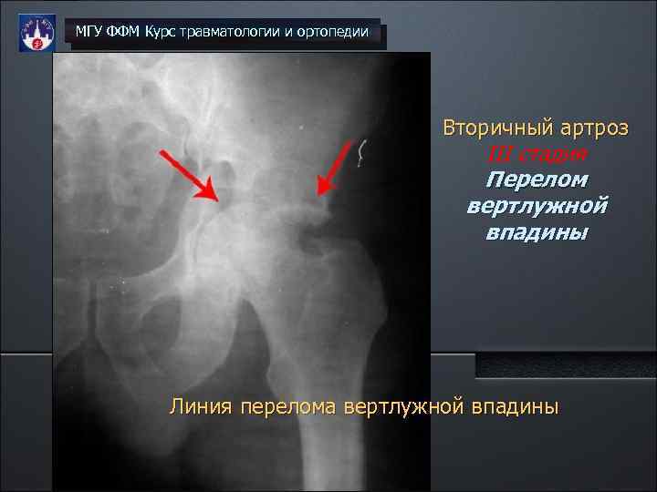 МГУ ФФМ Курс травматологии и ортопедии Вторичный артроз III стадия Перелом вертлужной впадины Линия