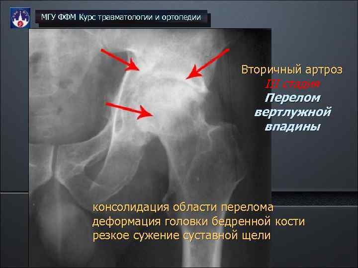 МГУ ФФМ Курс травматологии и ортопедии Вторичный артроз III стадия Перелом вертлужной впадины консолидация