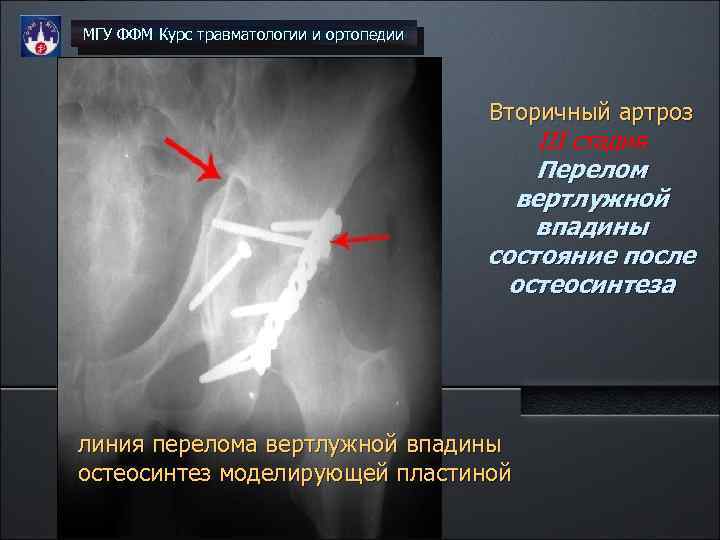 Перелом вертлужной впадины презентация