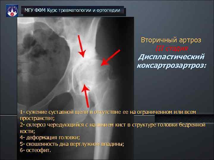 Коксартроз презентация травматология