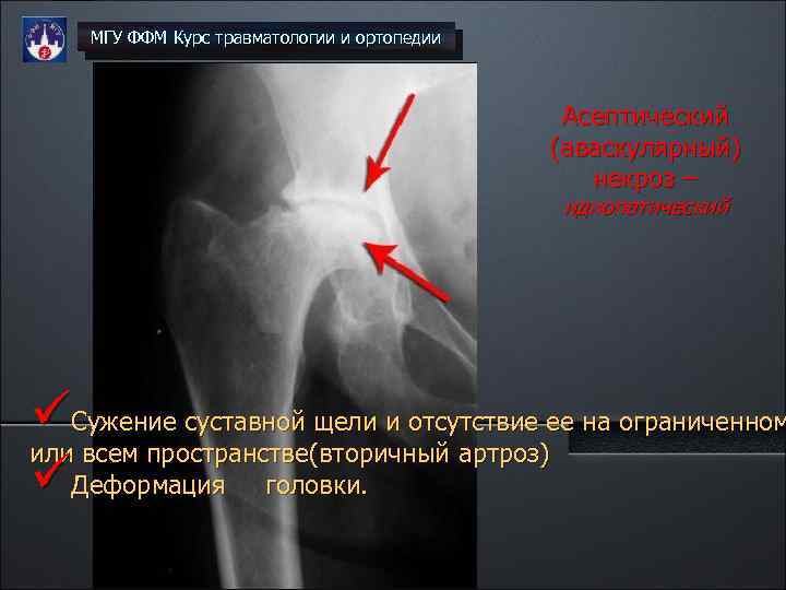 МГУ ФФМ Курс травматологии и ортопедии Асептический (аваскулярный) некроз – идиопатический üСужение суставной щели