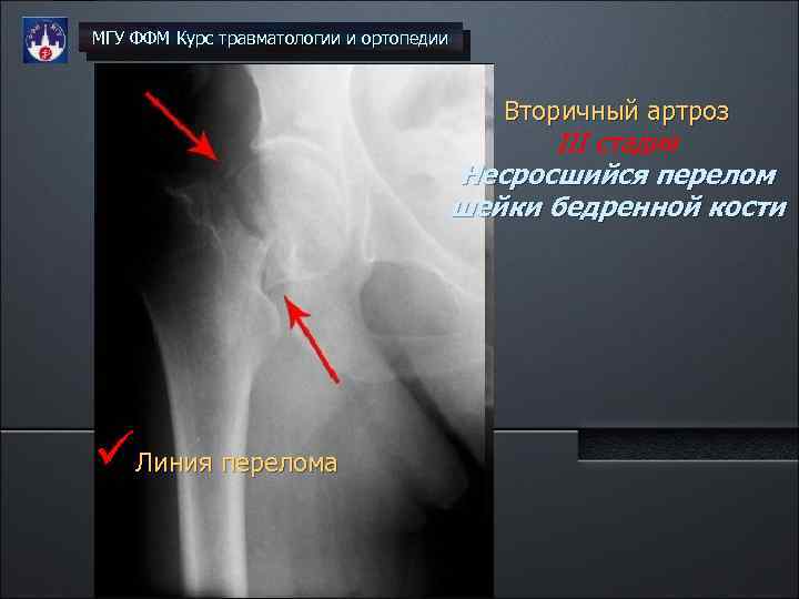 МГУ ФФМ Курс травматологии и ортопедии Вторичный артроз III стадия Несросшийся перелом шейки бедренной