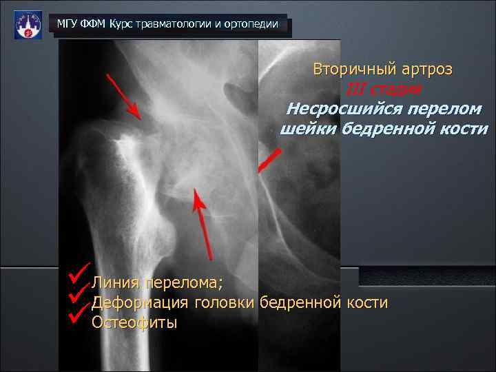 МГУ ФФМ Курс травматологии и ортопедии Вторичный артроз III стадия Несросшийся перелом шейки бедренной