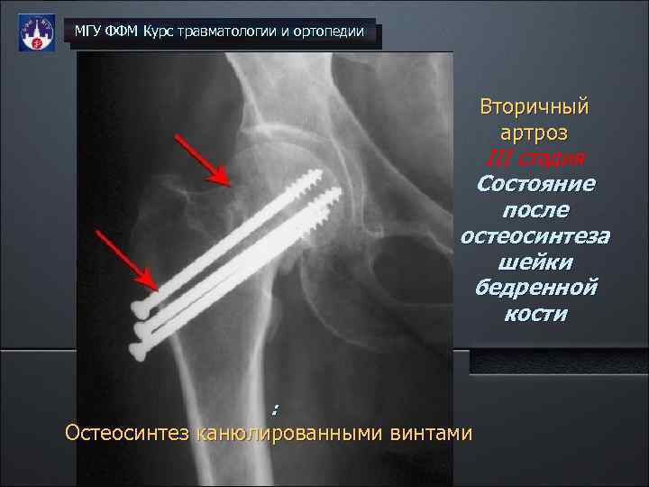 МГУ ФФМ Курс травматологии и ортопедии Вторичный артроз III стадия Состояние после остеосинтеза шейки