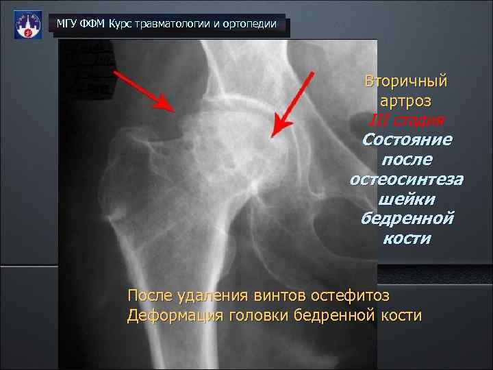 МГУ ФФМ Курс травматологии и ортопедии Вторичный артроз III стадия Состояние после остеосинтеза шейки