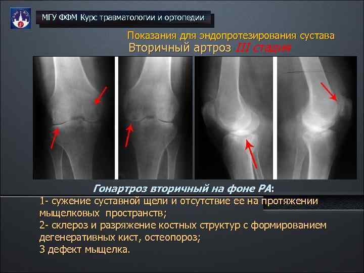 Гонартроз 2 степени