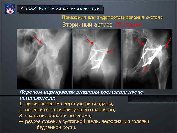МГУ ФФМ Курс травматологии и ортопедии Показания для эндопротезирования сустава Вторичный артроз III стадия
