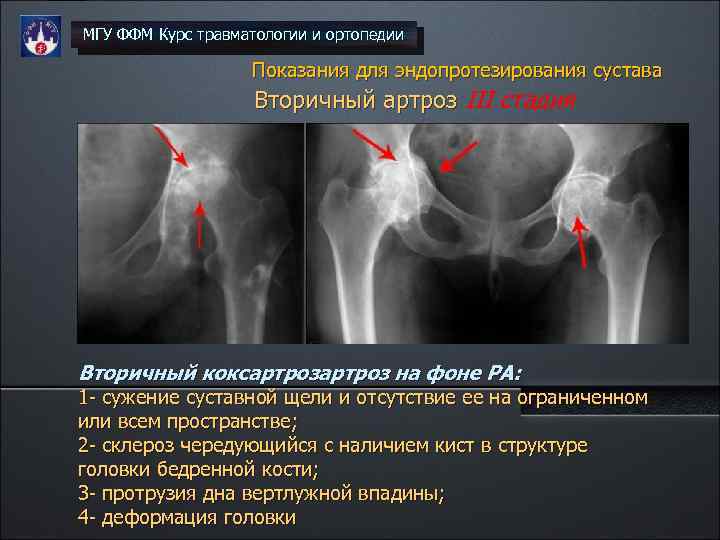 План лечения коксартроза