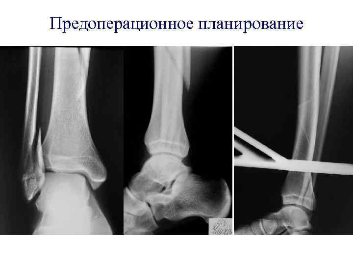 Предоперационное планирование 