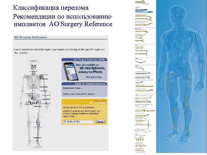 Классификация перелома Рекомендации по использованию имплантов AO Surgery Reference 