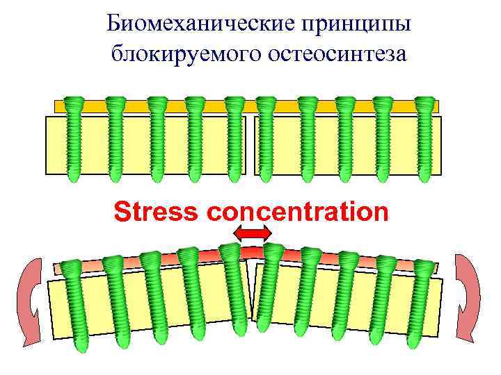 Биомеханические принципы блокируемого остеосинтеза Stress concentration 