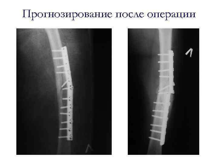 Прогнозирование после операции 