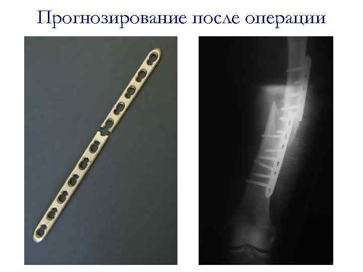 Прогнозирование после операции 