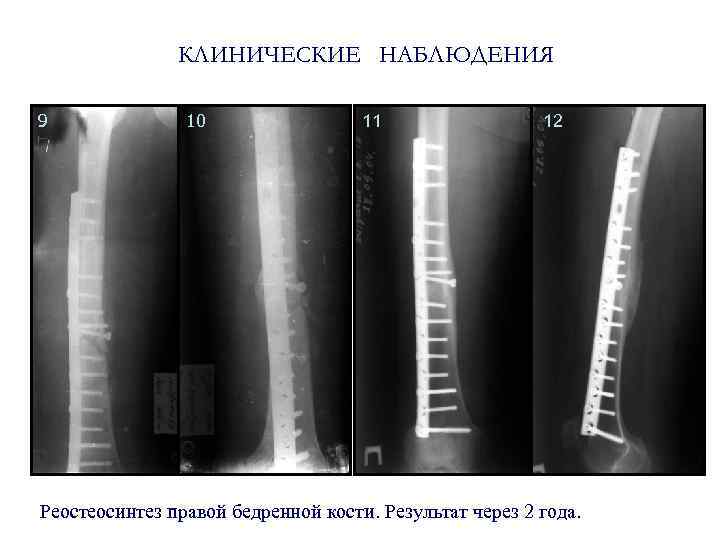 КЛИНИЧЕСКИЕ НАБЛЮДЕНИЯ 9 10 11 12 Реостеосинтез правой бедренной кости. Результат через 2 года.