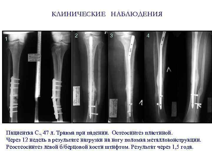 КЛИНИЧЕСКИЕ НАБЛЮДЕНИЯ 1 2 3 4 Пациентка С. , 47 л. Травма при падении.