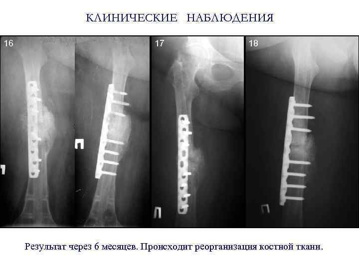 КЛИНИЧЕСКИЕ НАБЛЮДЕНИЯ 16 17 18 Результат через 6 месяцев. Происходит реорганизация костной ткани. 