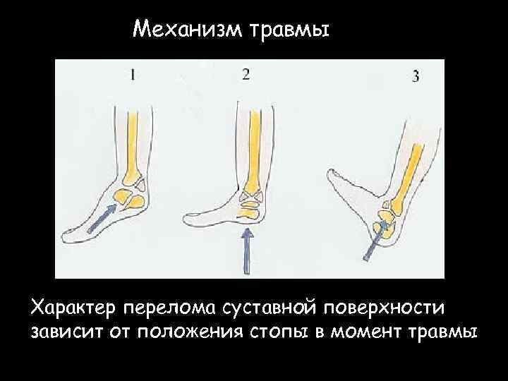 Механизм травмы Характер перелома суставной поверхности зависит от положения стопы в момент травмы 