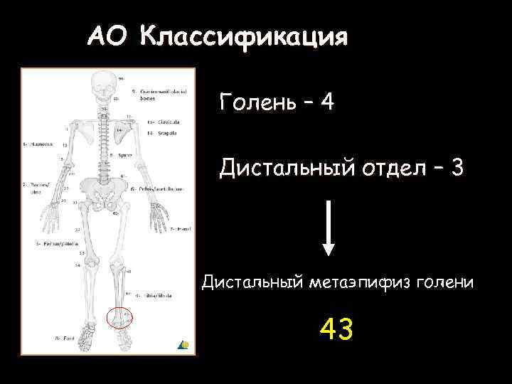 АО Классификация Голень – 4 Дистальный отдел – 3 Дистальный метаэпифиз голени 43 