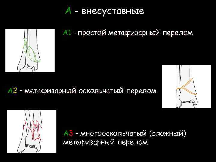 A - внесуставные А 1 – простой метафизарный перелом А 2 – метафизарный оскольчатый