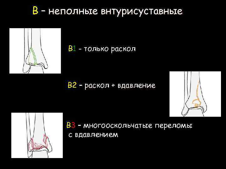 В – неполные внтурисуставные В 1 - только раскол В 2 – раскол +