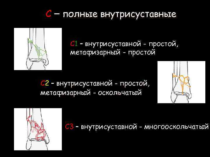 С – полные внутрисуставные С 1 – внутрисуставной - простой, метафизарный - простой С