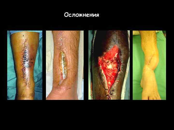 Осложнения 