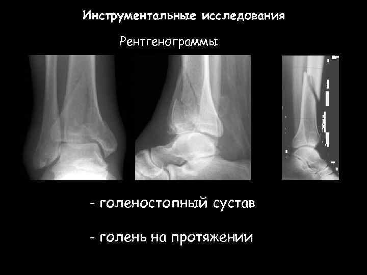 Инструментальные исследования Рентгенограммы - голеностопный сустав - голень на протяжении 