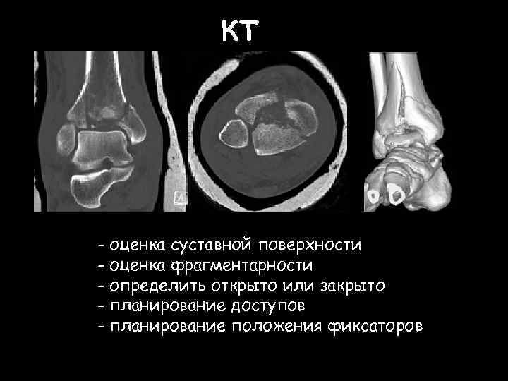 КТ - оценка суставной поверхности - оценка фрагментарности - определить открыто или закрыто -
