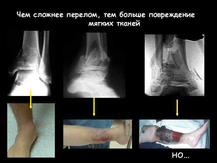 Чем сложнее перелом, тем больше повреждение мягких тканей но… 