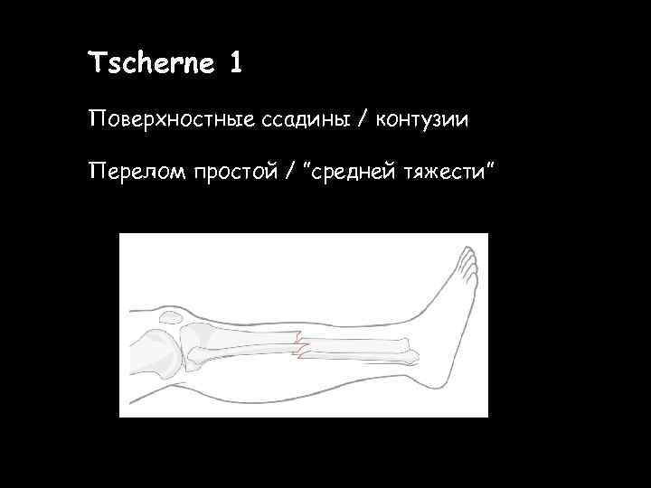 Tscherne 1 Поверхностные ссадины / контузии Перелом простой / ”средней тяжести” 