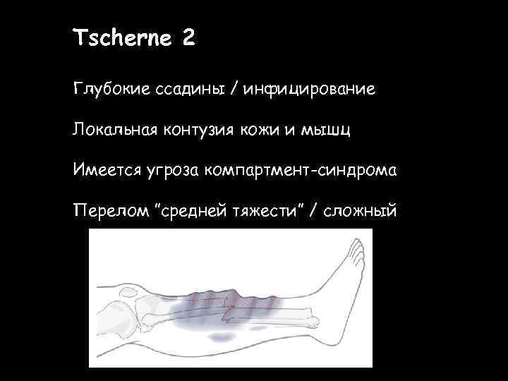 Tscherne 2 Глубокие ссадины / инфицирование Локальная контузия кожи и мышц Имеется угроза компартмент-синдрома