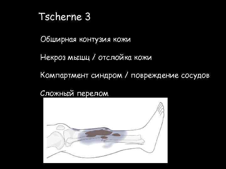 Tscherne 3 Обширная контузия кожи Некроз мышц / отслойка кожи Компартмент синдром / повреждение