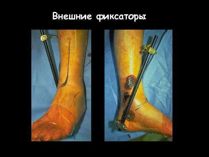 Внешние фиксаторы 