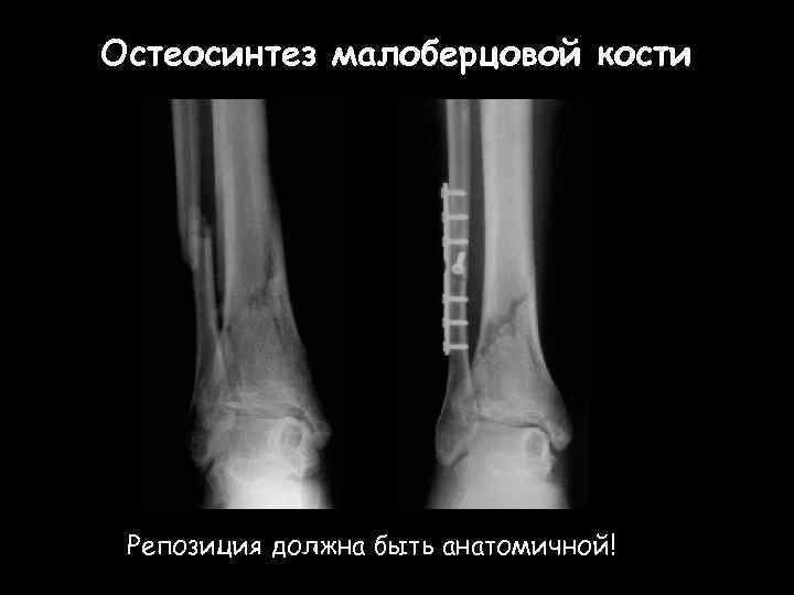 Остеосинтез малоберцовой кости Репозиция должна быть анатомичной! 