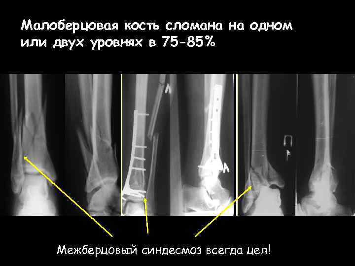 Малоберцовая кость сломана на одном или двух уровнях в 75 -85% Межберцовый синдесмоз всегда
