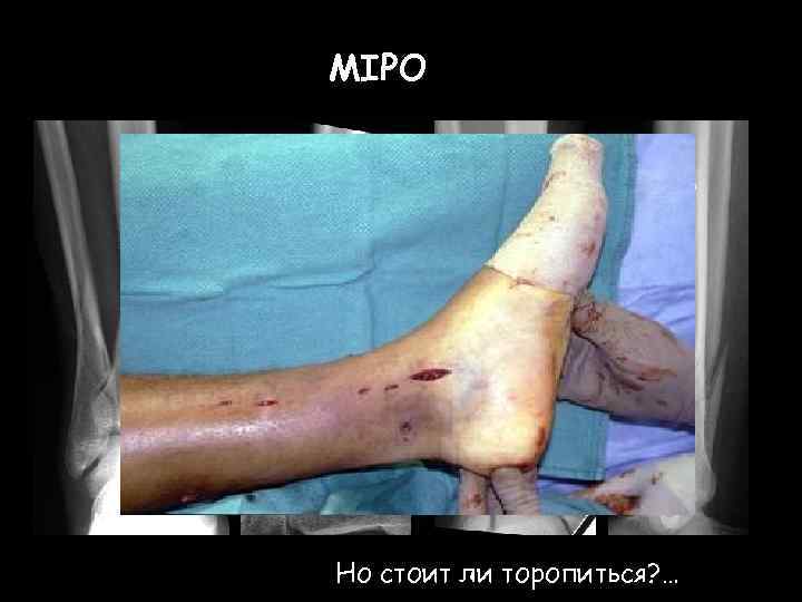 MIPO Но стоит ли торопиться? … 