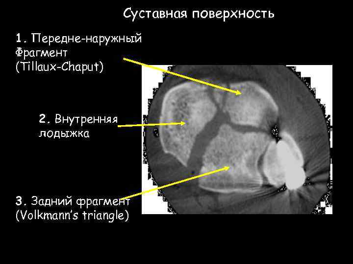 Суставная поверхность 1. Передне-наружный Фрагмент (Tillaux-Chaput) 2. Внутренняя лодыжка 3. Задний фрагмент (Volkmann’s triangle)