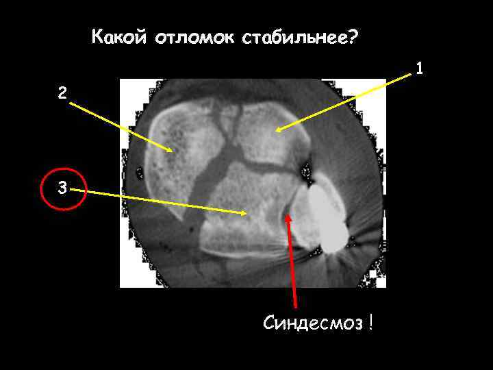 Какой отломок стабильнее? 1 2 3 Синдесмоз ! 