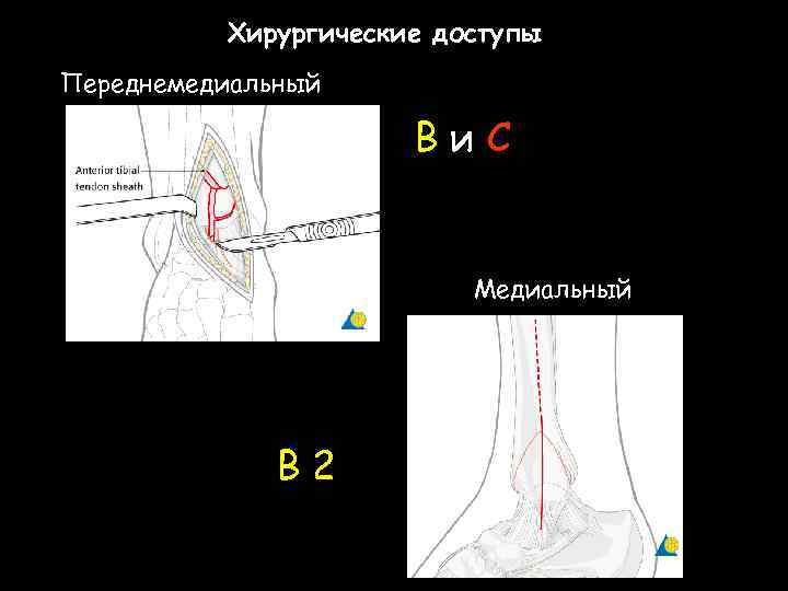 Хирургические доступы Переднемедиальный Ви. С Медиальный В 2 